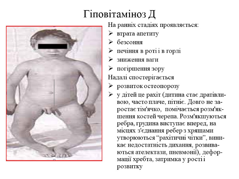 Гіповітаміноз Д На ранніх стадіях проявляється: втрата апетиту безсоння печіння в роті і в